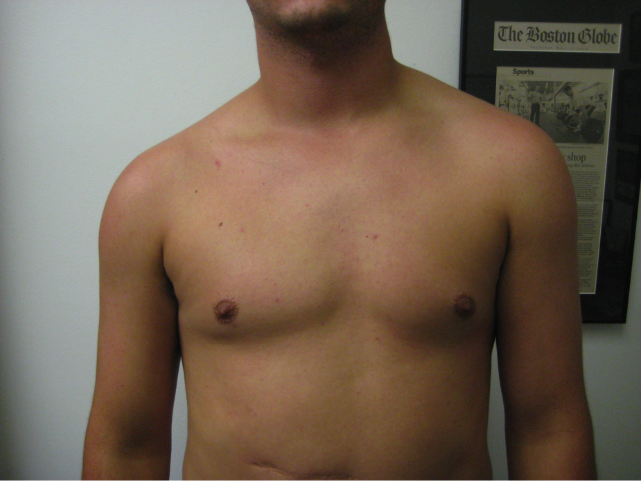 Pictures Of Patients With Clavicular Swelling 78